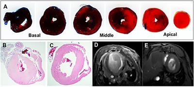 Modified GAN Augmentation Algorithms for the MRI-Classification of Myocardial Scar Tissue in Ischemic Cardiomyopathy